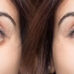 Effective Solutions For Reducing Under-Eye Bags
